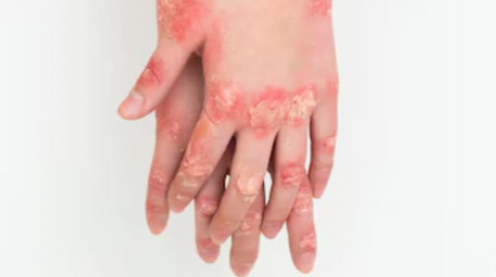 Kesehatan Anak Perlu Diperhatikan di Tengah Ancaman Wabah Mpox