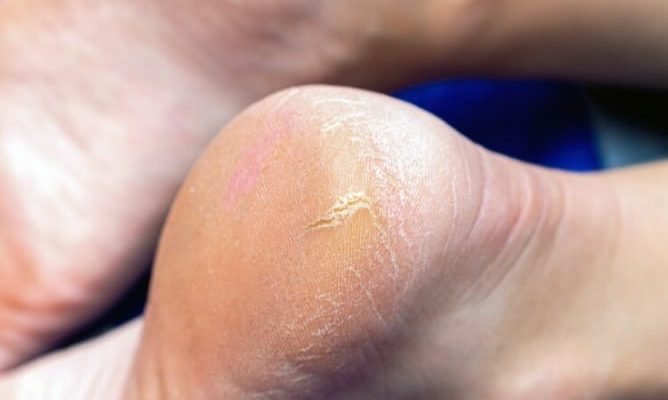 Apa Aman Kapalan Dikikis Sendiri? Ini Kata Dokter