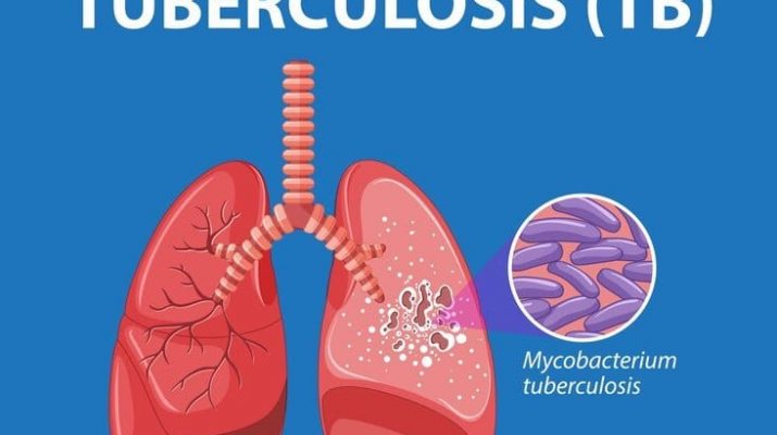 10 Ribu Kasus TBC di Surabaya, Dinkes Surabaya: Januari hingga November 2024