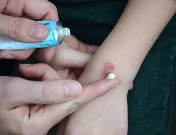 Ini Penyebab Bekas Luka tidak Hilang dan Tips Merawat Luka agar tidak Berbekas