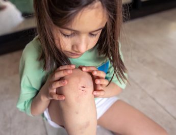 Jangan Oles Odol dan Kecap, Ini Cara Menolong Anak yang Terkena Luka Bakar