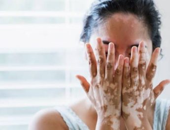 Terapi Vitiligo Secara Tepat Bantu Tingkatkan Kualitas Hidup Pasien