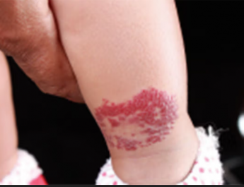 Waspada! Tanda Lahir Seperti Ini Bisa Jadi Tanda Bahaya Tersembunyi