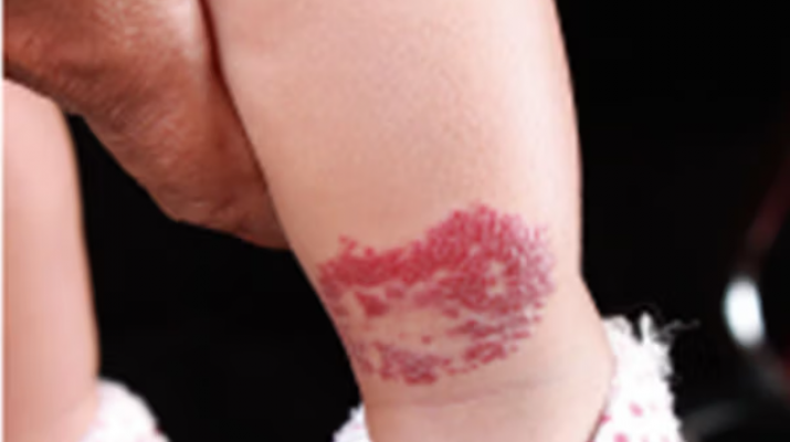 Waspada! Tanda Lahir Seperti Ini Bisa Jadi Tanda Bahaya Tersembunyi