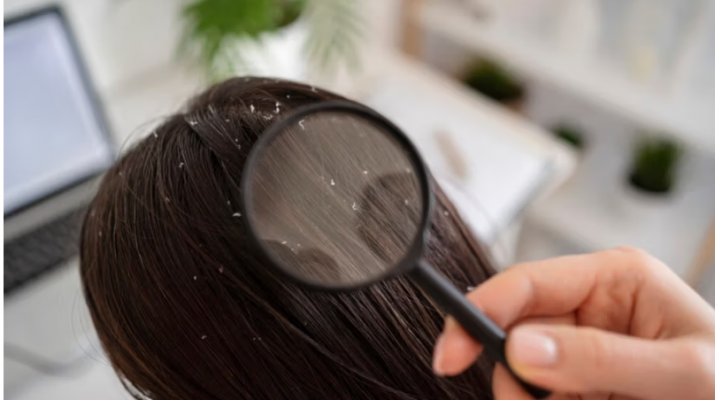 Pahami Dermatitis Seboroik yang Jadi Penyebab Ketombe