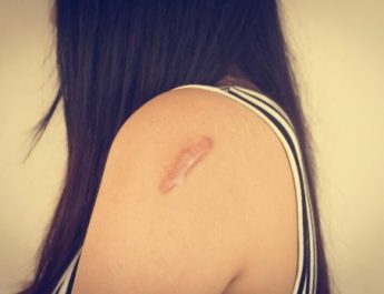 Scar: Pengertian, Jenis, dan Solusi Ampuh Mengatasinya