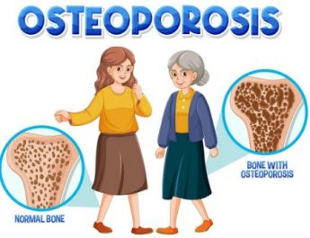 Osteoporosis tidak Hanya Menyerang Lansia, Usia Penderita Semakin Muda